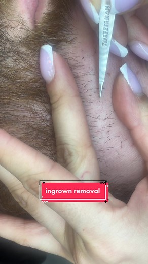 Ingrown hair removal 🙈 #fakebody #waxingvideos #ingrownhair #ingrownhairremoval #esthetician