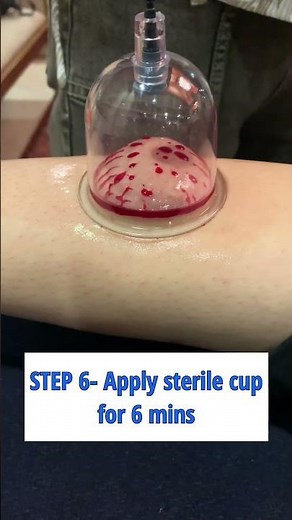 WET CUPPING TECHNIQUE #cupping #physiotherapy