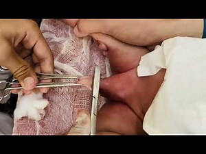 Surgery circumcision step by step and safe procedure by bone cutter