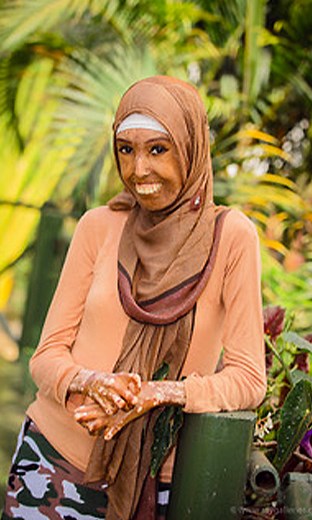 Living with Scleroderma: My Struggle with Excess Collagen and Stiffness #reels #viral #borndifferent #truly #Scleroderma #rarecondition #skincondition #skin #stiffness #collagen | Born Different