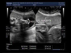 Ultrasound Video showing a case of Anencephaly.
