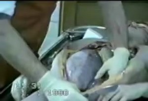 Cephalohematoma In Children In A Autopsy