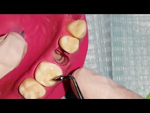 class I composite restoration for maxillary first molar