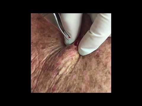 Repost of: Another method to pop out a cyst. For medical education- NSFE.