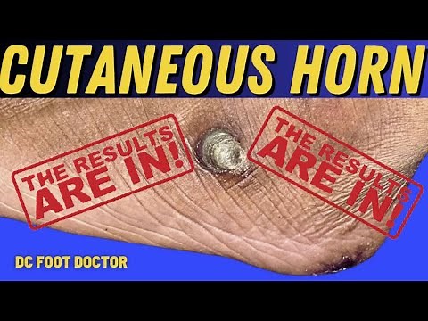 Cutaneous Horn: Part 2 - The Results Are In!