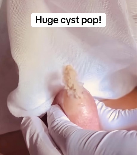 #pimple #zit #blackhead #cyst #spot #pimplepopperaddict #pimplepopper #asmr #ASMR #ingrownhair #ingrowntoenail #extractions #satisfying #satusfyingvideos #fyp #fy #fypシ #viralvideo #granosyespinillas #puntosnegros