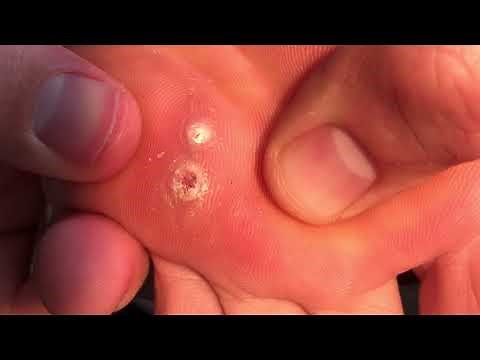 Day 29: Wart Update! Tweezers and Nail Clippers Expose this Beast!