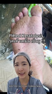 455K views · 3K reactions | น้ำท่วม บ้านพังไม่พอ เท้ายังพัง มาทำความรู้จักโรคเท้าเหม็น “Pitted keratolysis” #โรคเท้าเหม็น #PittedKeratolysis | Mhor Pimjai | Facebook