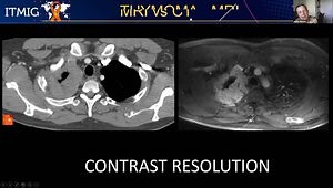 TNM Classification of Thymic Epithelial Tumors