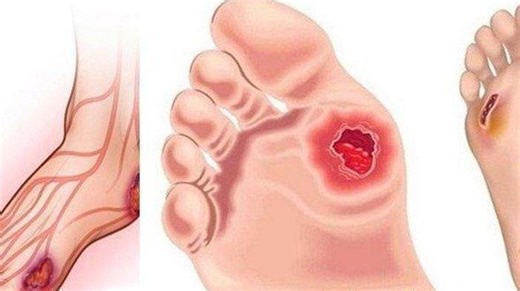 Memahami Perbedaan Diabetes Kering dan Basah, Begini Penjelasannya - TribunHealth.com