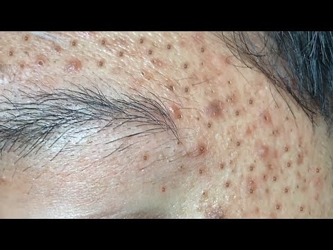 Make your Acne Treatment Huong Da Nang | 459# acne 2022