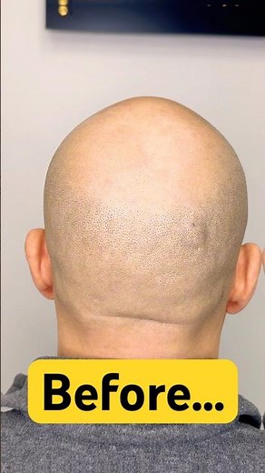 Hair Tattoo (SMP) Crown Transformation reveal! 👀