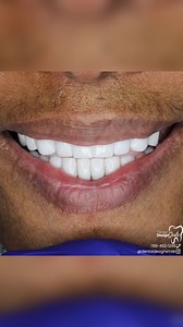 What are porcelain veneers!?🤩 Porcelain veneers are ultra-thin ceramic laminates that are bonded to the front surface of the teeth, correcting imperfections such as stains, gaps, misaligned or worn-down teeth.🤩🤩 They act as a protective layer that transforms your smile #dentaldesignsmile 🦷🦷 | Dental Design Smile