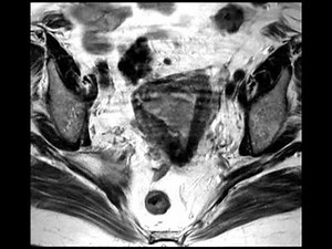 Endometrial Cancer with 50% myometrial invasion
