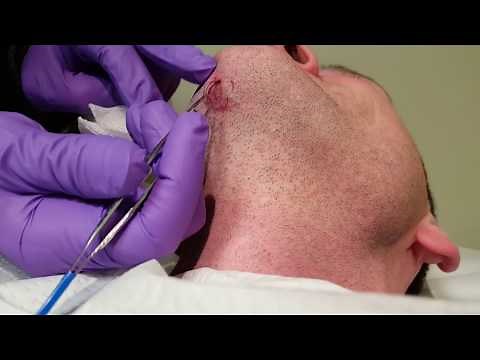 Ingrown Hairs - Four months of growth