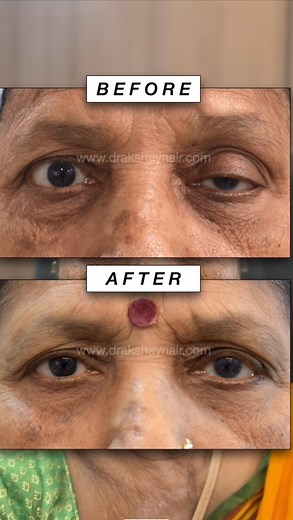 Ptosis or droopy eye is a condition where one eye appear smaller than the other due to a problem with the lid. This is something that can be treated at any age. We love sharing our patient stories, and here is one such transformation of a wonderful 70-year-old lady who came in for her left eye surgery. #CustomizedBeauty #eyelidsurgeonmumbai #PrecisionInSurgery #PersonalizedCare #BespokeResults #OculoplasticExcellence #IndiaSurgery #Botox #Ophthalmology #Ophthalmologists #OpththalmologyResidency