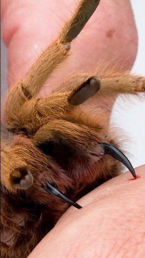 Tarantula Bites Me!