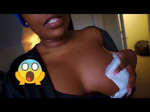 Vlog: Breast Augmentation Revision 350CC to 650CC