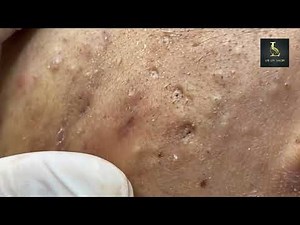 Best Blackhead Removal Ever - Facial Acne Treatment