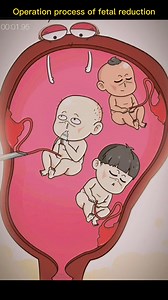 #fetus #fetal #reduction #operation #foryou #fyp #sciencefacts #mathematics#physics#life #subject #science #quantumphysics, #fyp #foryou #tiktok #lnteresting#science#physics | Sience