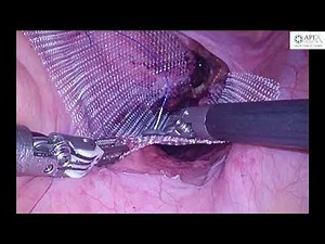 Robotic posterior mesh rectopexy