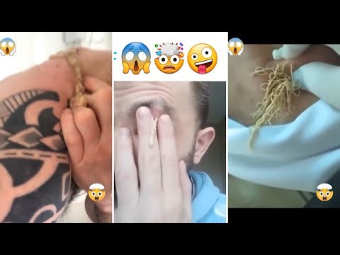 Best Satisfying Pimples Popping Cyst Removal Acne Blackheads Compilation Videos #18