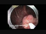 Colonoscopy Channel - En-bloc Snare Resection of Sessile Serrated Adenoma • Video • MEDtube.net