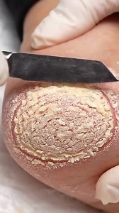 2.3K views | Foot Spa ASMR | Heel Rejuvenation 7CLM #footcare #heeleexfoliation #pedicure #oddlysatisfying #dryskinremoval Enjoy clean, relaxing foot-care ASMR with gentle heel exfoliation and natural callus removal. Disclaimer: AI-generated educational & relaxation content. | Viral video 427 | Facebook