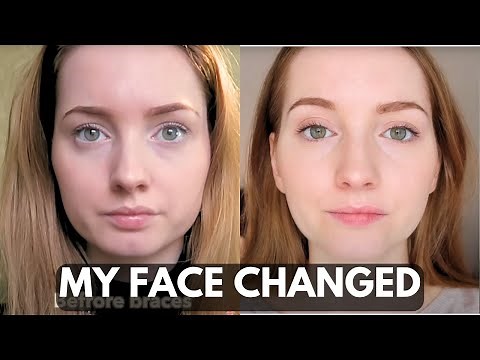 How Braces changed my face | my Entire Dental journey + photos