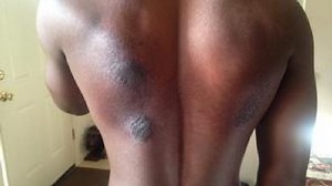 Springbrook High School football players suffer chemical burns from cleaning products