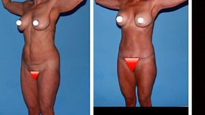 Tummy Tuck, Thigh Lift, Arm Lift, Lipo