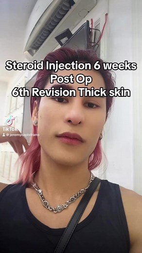Steroid Injection After 6th revision rhinoplasty #vietnamsurgery #revisionrhinoplasty #vietnamsurgery #surgiform #rhinoplastybeforeandafter #beautyandpurpose #beauty #primaryrhinoplasty #androidaesthetics | Jeremy Capistrano