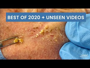Best Pimple Popping Videos of 2020 + Unseen Blackhead and Cyst Videos | CONTOUR DERMATOLOGY