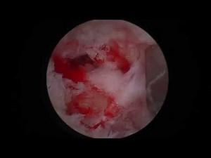 Unilateral Biportal Endoscopic Spinal Surgery in a dog(Mini-Hemilaminectomy)