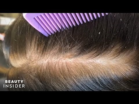 How Severe Dandruff Is Removed From The Scalp | Insider Beauty