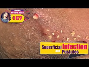 Superficial Infection an Pustules Removal - Acne Treatment (#67)