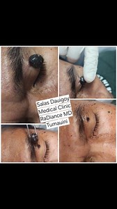 Mole removal procedure #RaDianceMDclinicTumauini #SalasDauigoyClinic 09664082404 to schedule  | Salas Dauigoy Medical Clinic | Facebook