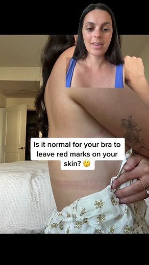 Understanding Indentations from Wearing a Bra | Normal Skin Marks Explained
