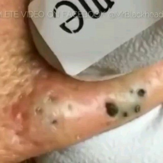 Pimple Popping 2021 on Instagram: "Follow us 👉 @popmypimple2022 for more pimple popping videos😘 #pores #acne #skincare #blackheads #pimples #whiteheads #pimple #blackhead #skin #beauty #blackheadextraction #blackheadremoval #pimplepopping #whitehead #pimplepop #pimplepoppers"
