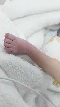 Case 195 rocker bottom foot, congenital vertical talus, diastrophic skeletal dysplasia with cleft p