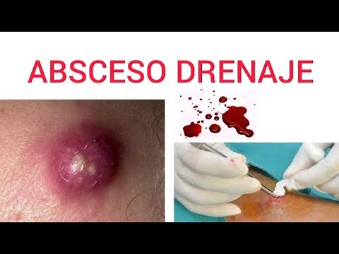 Procedimiento paso a paso del drenaje de un absceso en espalda.