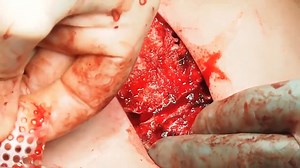 M - Surgical correction of pectus carinatum