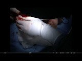 Glanuloplasty With Urethral Flap After Partial Penectomy • Video • MEDtube.net