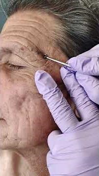 Acne extraction of blackheads and whiteheads (popping pimples in Los Angeles)