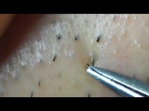 Pull Out Unwanted hair Bristle use tweezers【Hair remove prinsess 2019a-006】