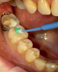 Ceramic Overlay try-in 醴 By • @dr.minigulov #ceramic #venner #onlay #caries #conservative #restoration #dentist #tooth #explore #teeth #gum #mouth #dental ‏ #dentistrylove #dentalhygiene #dentalassistant #dentistrysocial #dent #mouth #bay #odontologia #veneers #parodontologia | Dentistry blog | Facebook