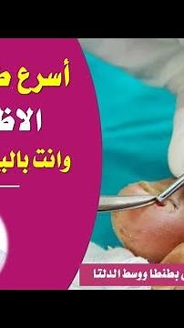 اسرع طريقه فعاله لعلاج الأظفر الغائر وانت فى البيت بدون جراحه | دكتور طارق تركى