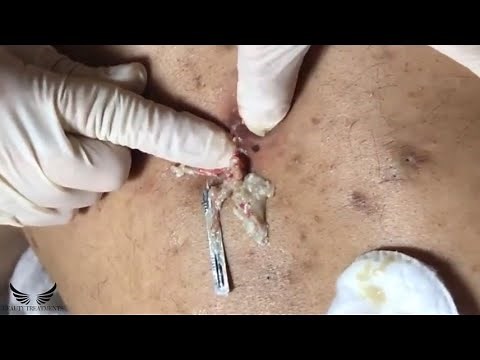 Cystic Acne Treatment - Blackhead Removal - Back Pimple Popping - Hidden Acne Spa Relaxing | #096