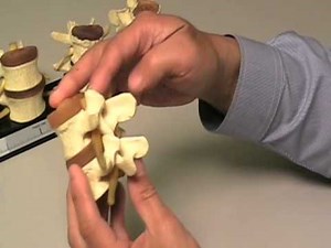 Degenerative Disc Disease Basic Terminology - Disc Herniations, Osteophytes, Stenosis