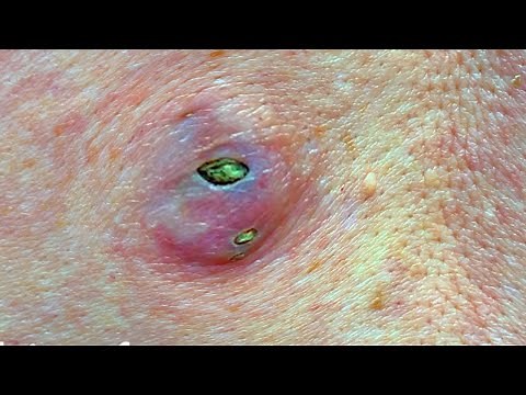Biggest Pimples, Largest Cysts, Acne, Whiteheads and Big Zits